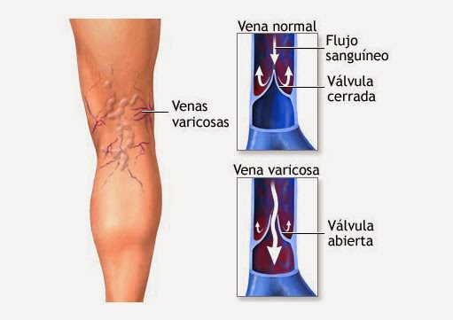 VARICES