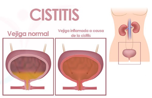 Cistitis_FB